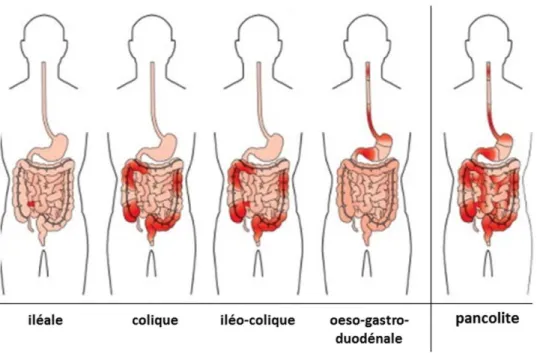 Figure 16 : Différentes localisations possibles de la maladie de Crohn                                                                                  (image modifiée d’après Baumgart and Sandborn, 2012) 