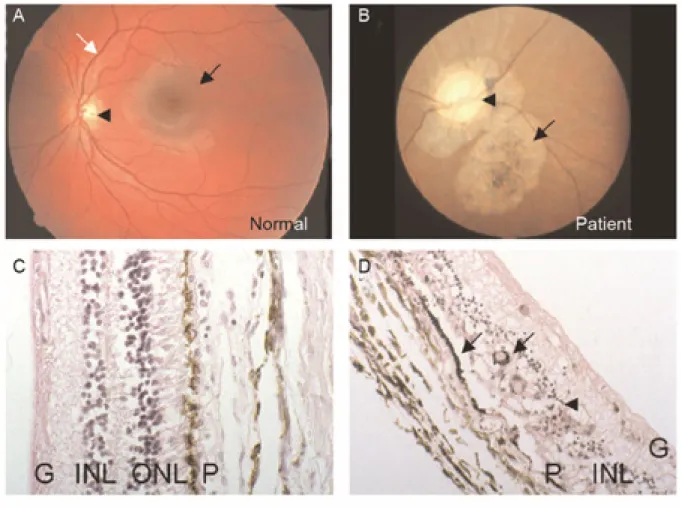 Figure 3 Hallmarks of SCA7 human retinopathy.  