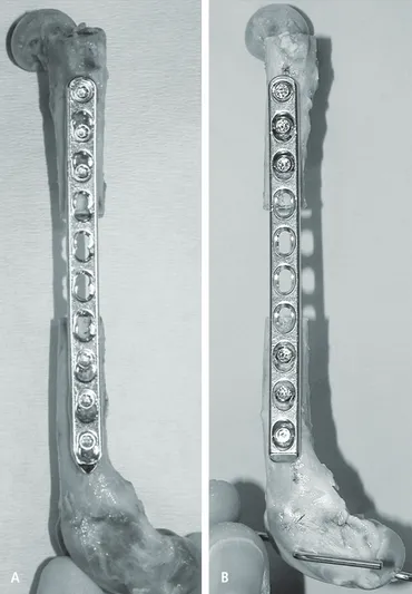 Figure 1    Photographs showing  the locking  compres-sion plate (A) and   limited contact   dynamic compression  plate (B) constructs.