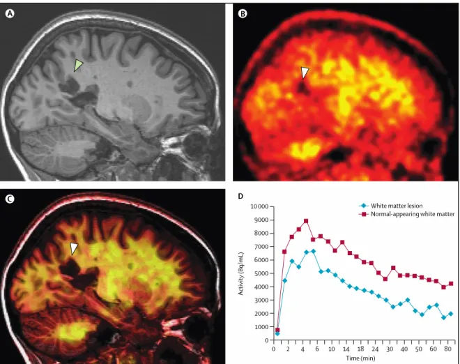 Figure  7:  [11C]PIB    in  MS.  The  uptake  of  [11C]PIB  is  lower  in  MS  lesions  compared  with  normal-appearing  white  matter  in  patients  with  MS,  suggesting  the  presence  of  demyelination
