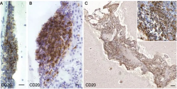 Figure 15: B-cell follicle-like structures in meningeal space of SPMS patient. (A, B) follicle  of modest size