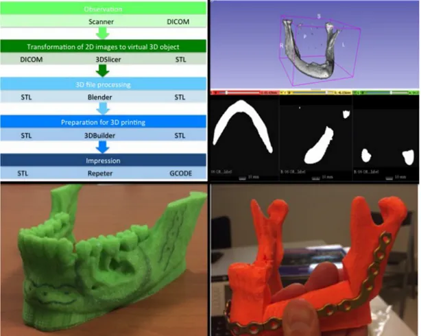 Fig. 1. A. Free digital chain allowing 3D printing of mandible templates from DICOM ﬁles
