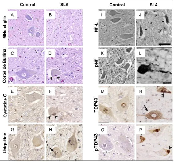 Figure 5 | Neuropathologie classique de patients atteints de SLA. (A-B, 20X) Perte des MNs et gliose  de  la  corne  antérieure  de  la  moelle  épinière  d’individus  SLA