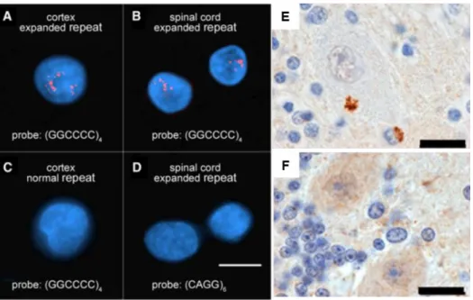 Figure  8  |  ARNs  foci  et  accumulation  de  protéines  dipeptidiques  dans  les  tissus  de  patients  porteurs d’expansions au niveau du gène C9ORF72