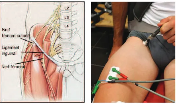 Figure  6.  Situation  anatomique  du  nerf  fémoral et  positionnement  de  lélectrode  de  stimulation  (ou cathode) au niveau du triangle fémoral