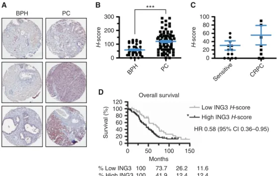 Figure 2. The expression of ING3 is a poor prognostic marker for PC patients. (A) Prostate tissue microarray (TMA) were stained for ING3 by immunohistochemistry (B) TMA were scored for positive staining (histoscore or H-score)