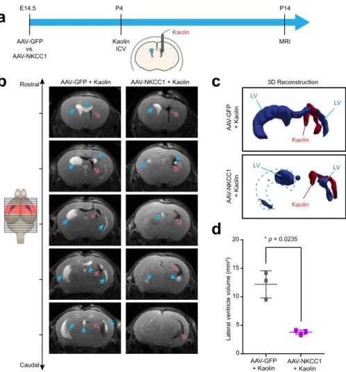 Fig. 6 ChP NKCC1 overexpression mitigates ventriculomegaly in an obstructive hydrocephalus model