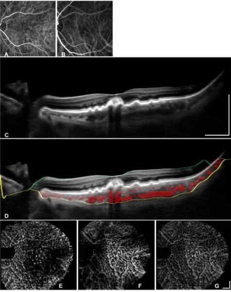 Figure 3. Segmentation validation in a non-neovascular AMD eye via a comparison of the segmented vasculature with indocyanine green angiography (ICGA)