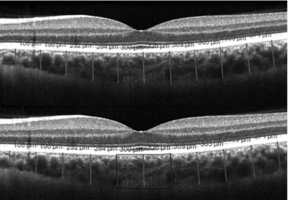 FIGURE 1. Choroidal thickness measurements on Cirrus HD-OCT high definition 1 line raster scans