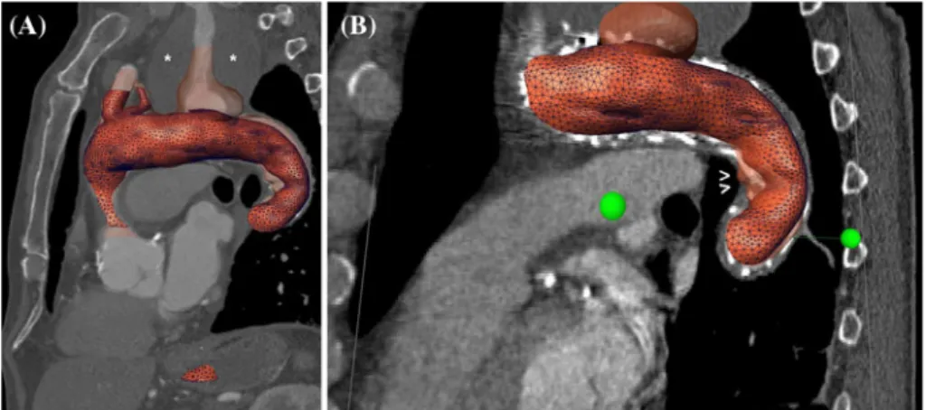 Fig. 5 Geometric analysis of a thoracic endografting for a descending thoracic aortic aneurysm: a case of skewness of the vascular profiles.