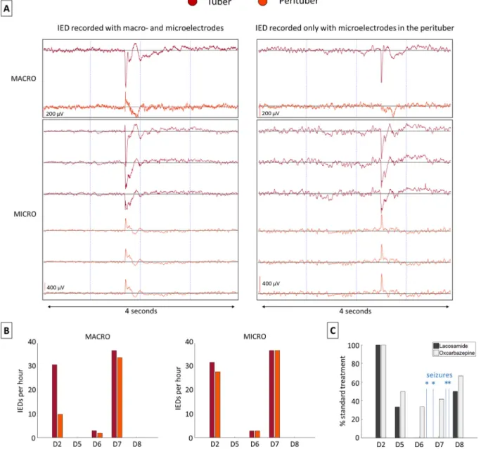 Fig. 3. (A) Example of an IED recorded simultaneously in the tuber (red) and perituberal tissue (yellow) with macro- and microelectrodes, and an example of another IED recorded in the perituberal tissue solely with microelectrodes