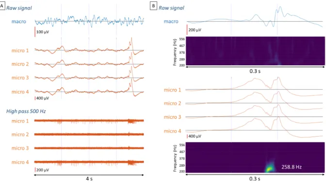 Figure 7 - Contributions of microelectrode recordings. (A) An interictal epileptic discharge 