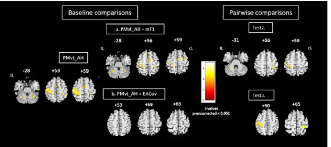 Fig. 4. Group comparisons for affected hand. Left panel: Brain activity associated with passive extension of affected wrist  (baseline comparison:  task vs