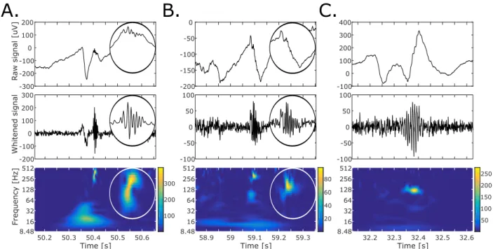 Figure 1: Examples of high-frequency oscillations (HFOs) in time and time–frequency domains