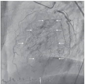 Figure 2: Angiographic image of the left coronary artery showing the Thebesian veins.