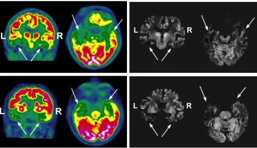 Fig. 1. Visual comparison of ASL and FDG-PET illustrated for 2 patients. Left, PET data with metabolism decreasing from red to green; right, PVE CBF maps
