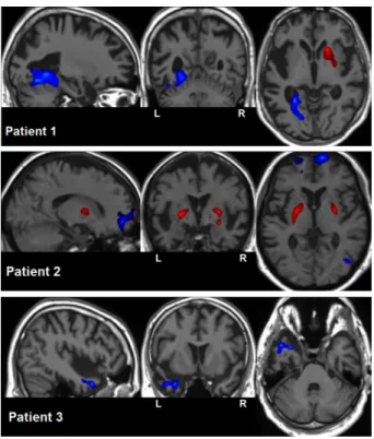 Fig. 2. Voxelwise individual statistic analysis: for 3 patients, detected hypoperfusions (blue) and hyperperfusions (red) superimposed on their anatomical map.