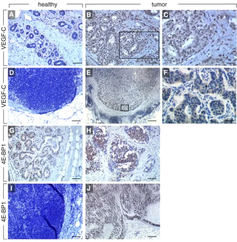 Figure 1. Expression Levels of VEGF-C and 4E-BP1 in Breast Tumor Specimens (A–F) Immunostaining of VEGF-C in human  spec-imens of healthy breast tissue (A), invasive breast cancer (B and C), and in healthy (D) and  metasta-sized (E and F) lymph nodes