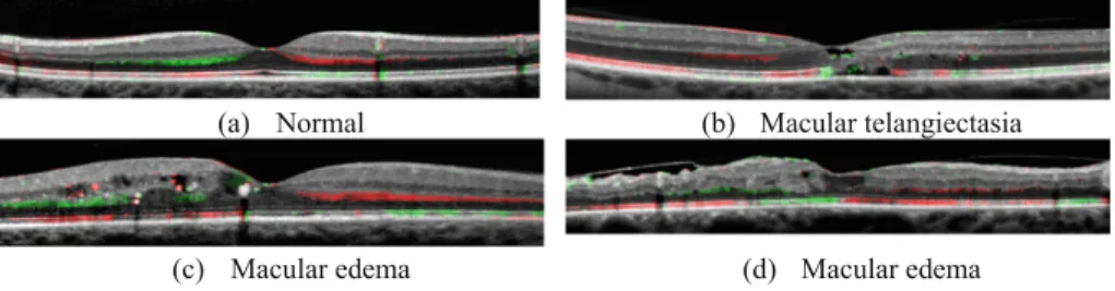 Fig. 9. Some clinical results. (a) Control patient, with uniform color in each hemiretinas;