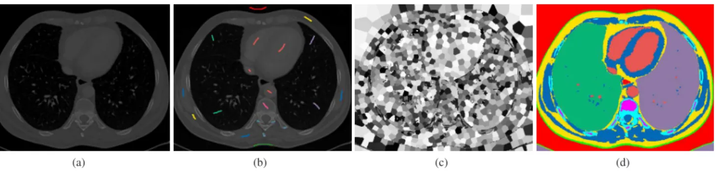 Figure 5: Segmentation of the lungs in a CT volume. Left/Right : without/with anatomical spatial priors respectively