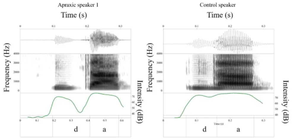 Figure 1. Waveform, spectrogram (0-5kHz) and amplitude (dB) of the syllable /'da/ in the word  dato (‘information’) produced by a control (right) and an apraxic speaker (left), showing 