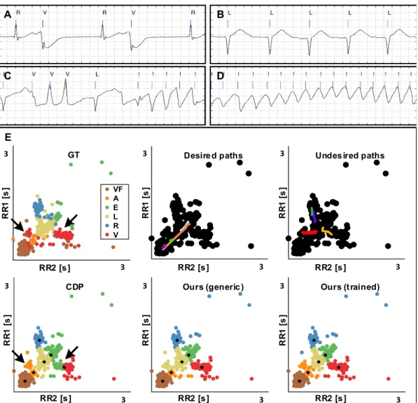 Figure 5.6. Recognition of different heart rhythms. A-D. Fragments of an ECG signal from a patient with several types of arrhythmia