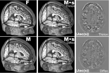 Fig. 3. Registration of two synthetic T1 MR images of distinct anatomies. For visually similar results, our algorithm provides smoother diffeomorphic transformations.
