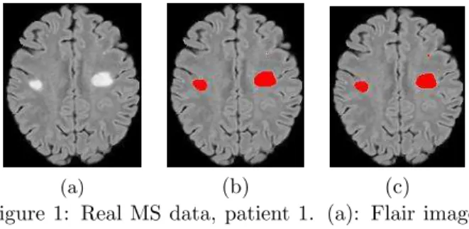 Figure 1: Real MS data, patient 1. (a): Flair image.
