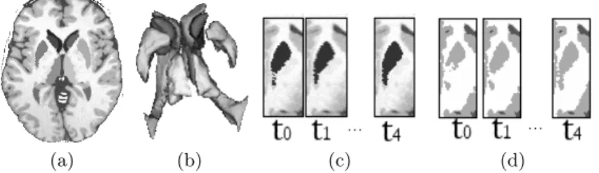 Fig. 4. Segmentation by LOCUS-TS on BrainWeb(a), 3D reconstruction(b), gradual improvement of putamen segmentation(c) and corresponding tissue segmentation(d).