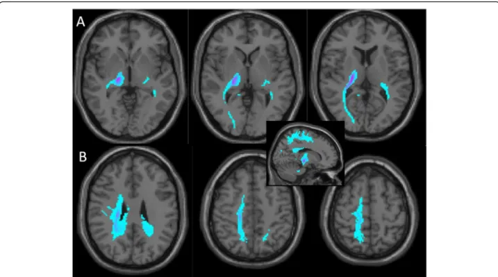 Fig. 2 Probabilistic connectivity of the right thalamic lesion based on Magnetic Resonance Imaging (Diffusion Tensor Imaging)