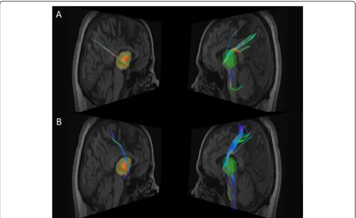Fig. 3 Fiber tracts connection between the right thalamic lesion area and respectively the precuneus (a) and the superior parietal lobule (b) from Brain Magnetic Resonance Imaging (Diffusion Tensor Imaging)