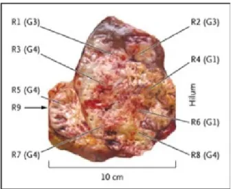 Figure 1.1 – Illustration de l’h´et´erog´en´eit´e tumorale par [Gerlinger et al., 2012] pour une tumeur r´enale