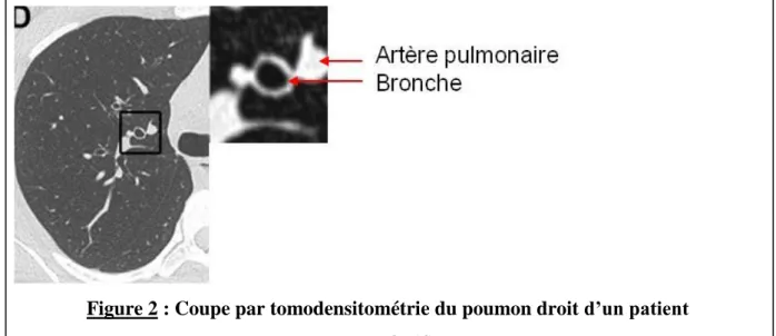 Figure 2 : Coupe par tomodensitométrie du poumon droit d’un patient   D’après (4) 
