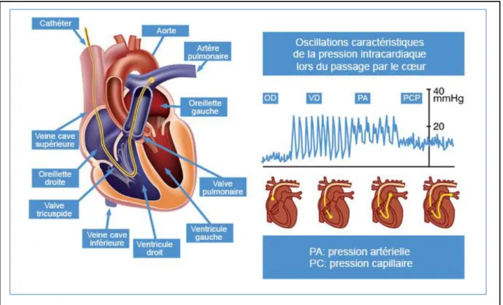 Figure 5 : Mesure par cathétérisme cardiaque droit des différentes pressions cardiaques  droites et artérielles pulmonaires 