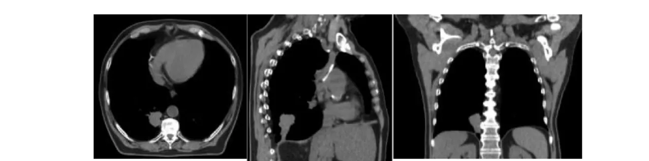 Figure I-3 : Images de scanner thoracique, coupe axiale, sagittale et coronale. 