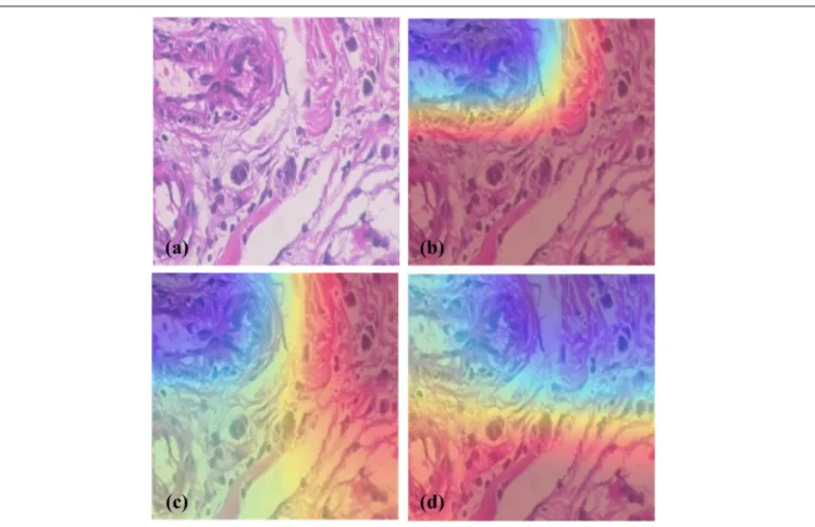 FIGURE 5 | Heatmap generated by different models. (a) A slide of Ductal Carcinoma seen in 200 × magnification factor, (b) Heatmap of InceptionV3, (c) Heatmap of InceptionV3+SE Block, (d) Heatmap of InceptionV3+BCNNs
