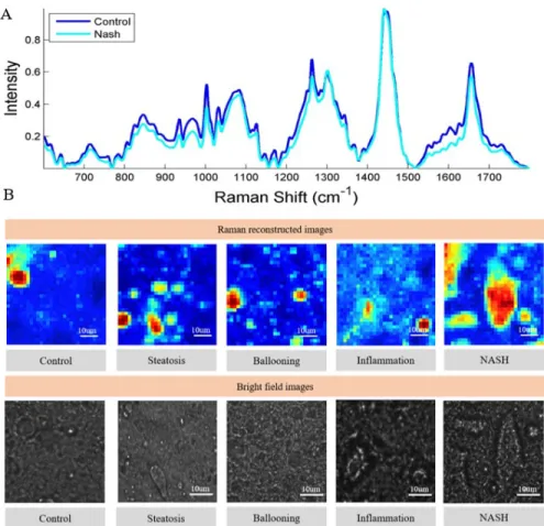 Fig. 2. A) The averaged Raman spectrum of control and Non-alcoholic steatohepatitis (NASH) groups across 871 Raman shifts