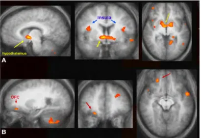 Figure 1.4 – Images IRMf obtenues sur une population adulte de patients avec un SPW. En rouge, nous retrouvons les aires cérébrales fortement activées en réponse à des images de nourriture