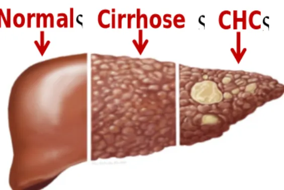 Figure  6  :  Représentation  illustrée  de  la  modification  des  cellules  hépatique  selon  le  stade de la maladie