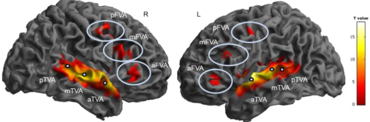 Fig. 1. Random effect analysis in 92 subjects. Suprathreshold clusters showing higher activation for the contrasts V vs NV (N ¼ 92, p < 0.05 FWE voxel-level corrected, extent threshold ¼ 0 mm 3 )