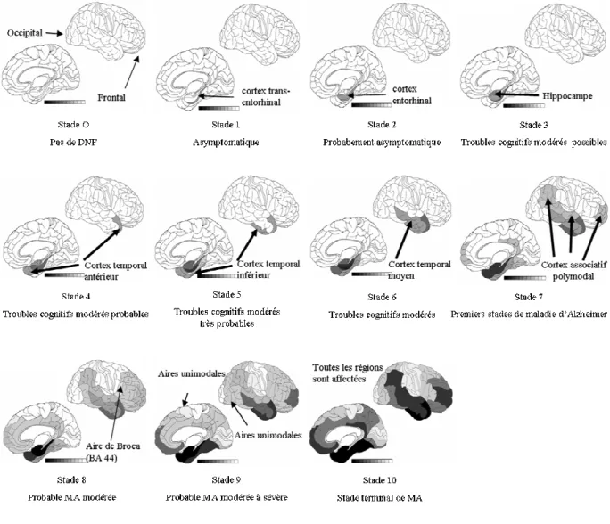 Figure 15: Evolution  de  la  distribution  des  dégénérescences  neurofibrillaires  dans  le  tissu  cérébral  au  cours du développement de la maladie d'Alzheimer 