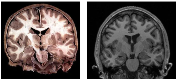 Figure 2:2 Visualisation de coupe coronale d’un cerveau (a) après dissection (b) en utilisant une IRM  anatomique avec pondération en T1