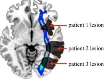 Figure 1: Brain damages can occur in different locations but disconnect the same white matter tract; they can have the same behavioural consequences without any overlap