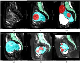 Fig. 1. MR images of uterus regions in different patients. Red denotes the fibroids, blue the uterus, and green the spine