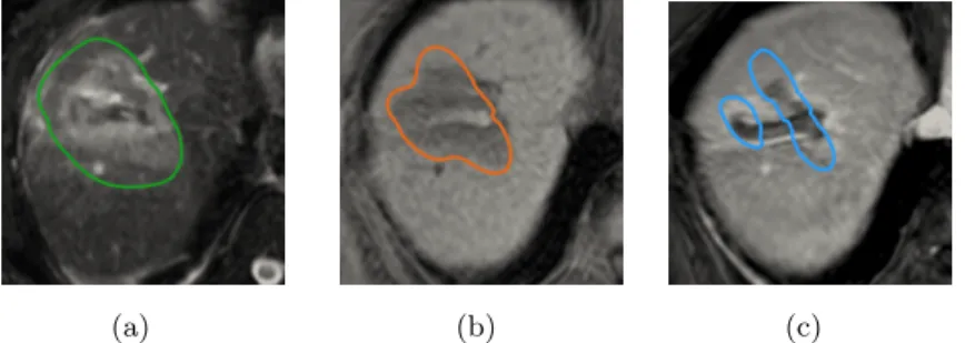 Figure 8. Cross section of the isolines 300, 500 and 650 V.cm −1 registered respectively on T2 (a), unenhanced (b) and enhanced at delayed phase of intravenous injection of gadolinium (c) of T1 weighted images.