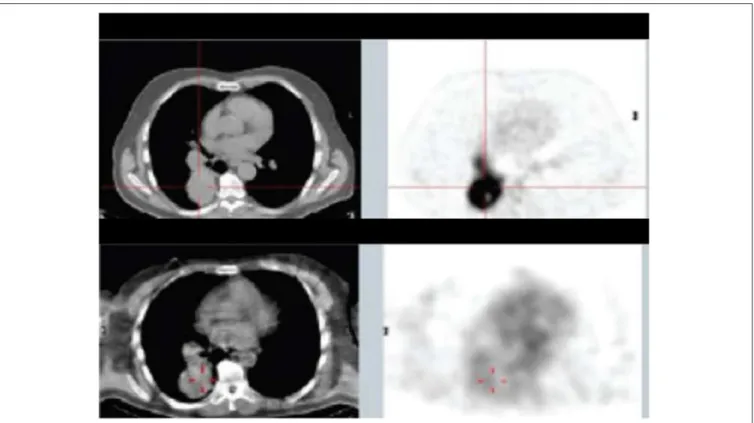 FIGURE 5 | Patient from Phase Ia study with mediastinal and lung metastases: top panel— 18 FDG PET/CT 10 days before the study, lower panel—SPECT/CT of 188 Re-6D2 mAb at 2 h after injection [from Klein et al