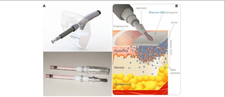 FIGURE 10 | Rhenium-SCT device developed by OncoBeta ® GmbH (Garching, Germany). Applicator and dispensing carpoules filled with 188 Re-cream (A) and illustration of the principle (B) (Courtesy of Dr