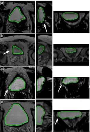 Fig. 4. Five examples of segmentation results obtained with the proposed deformable model