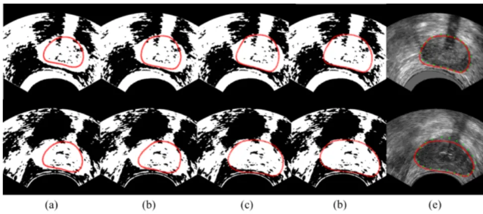 Figure 7: The results of prostate segmentation by using Active Shape Model with Rayleigh Mixture Model clustering method for two patients.