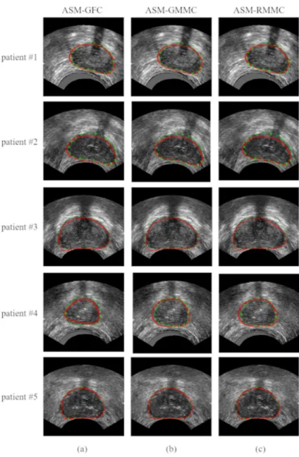 Figure 9: The results of prostate ultrasound image segmentation for five patients (#1 - #5).